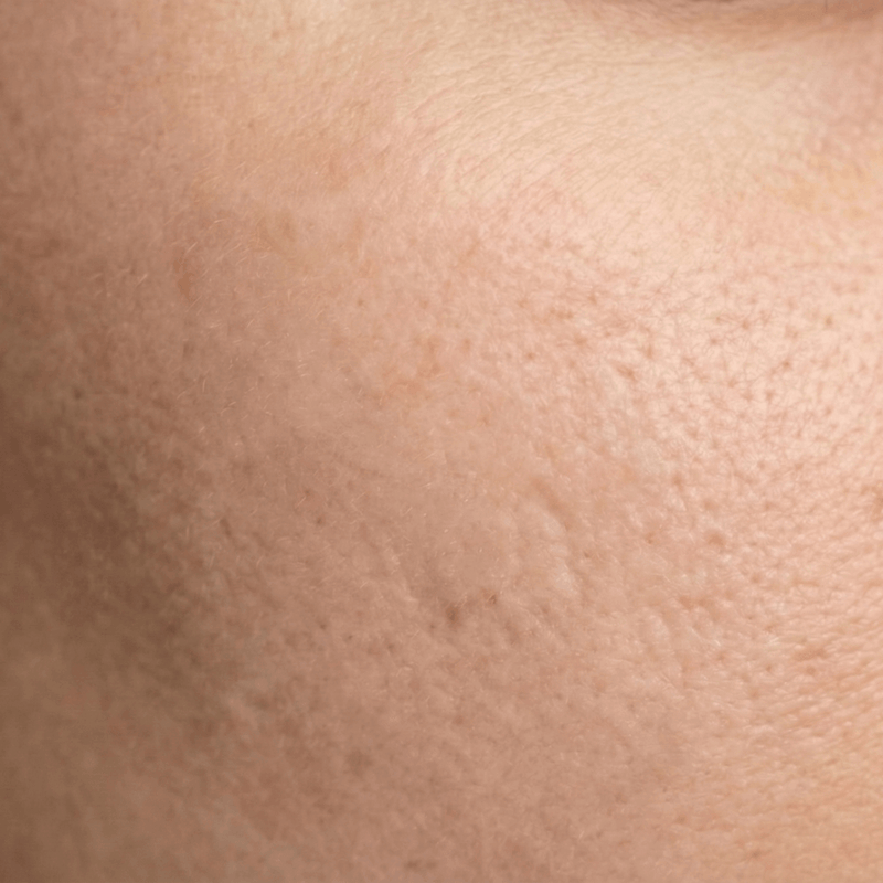 After Acne scars faded