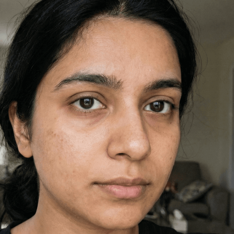 Before Dark Spots Faded 70%